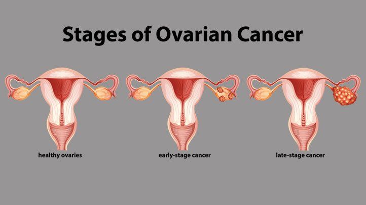 ovarian cancer stages 722x406 1