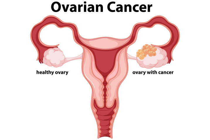 ovarian cancer